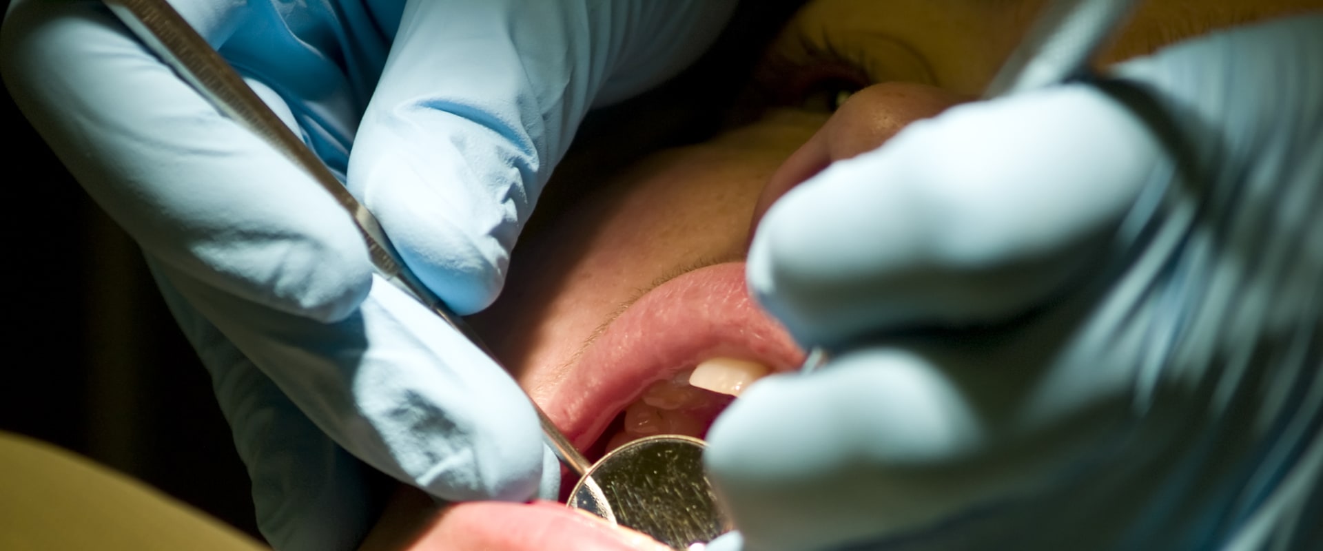 Do Emergency Dentists Perform Root Canals?