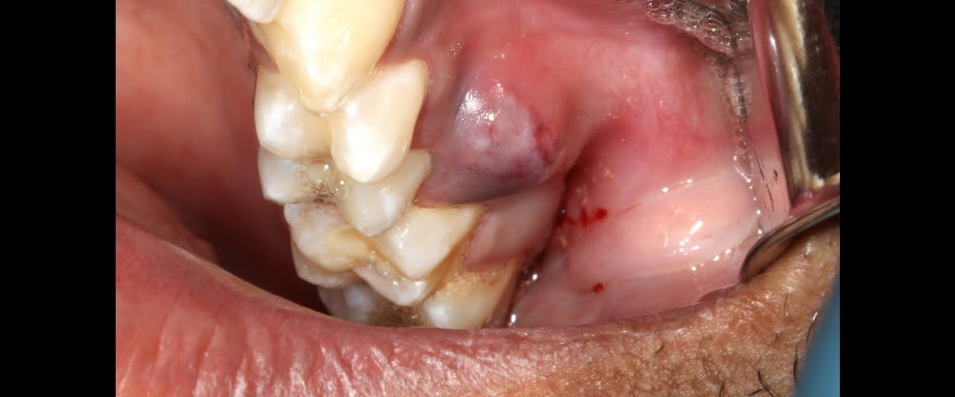Can a Dentist Pull an Infected Tooth?