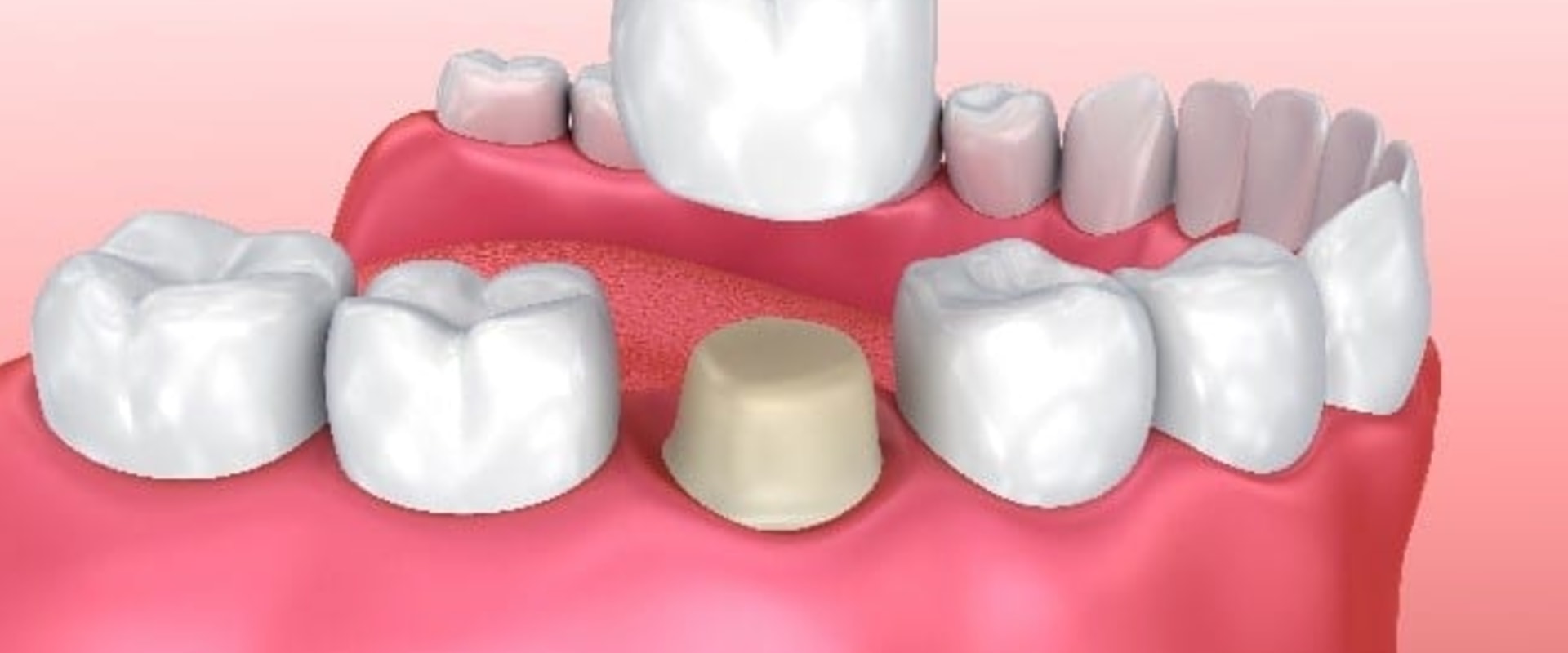 Can an Emergency Dentist Provide a Temporary Crown on the Same Day?
