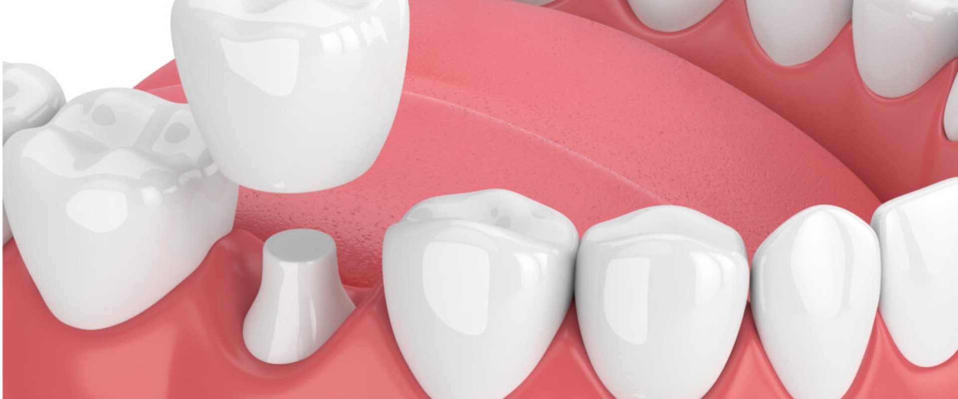 Can an Emergency Dentist Provide You with a Permanent Crown on the Same Day of Your Visit?