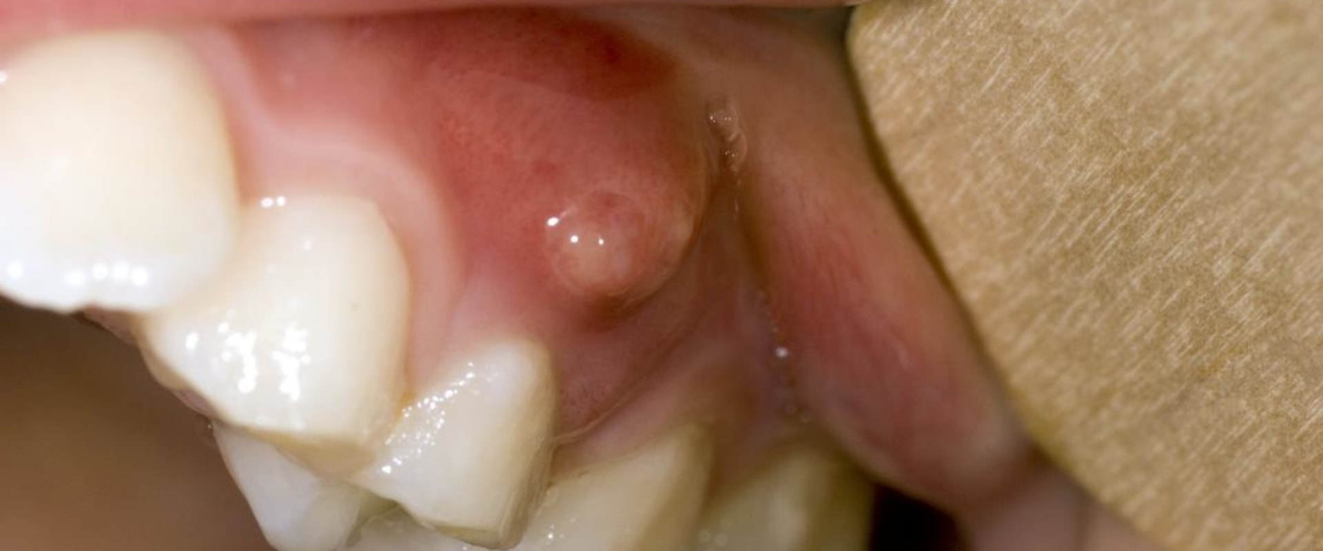 How to Treat and Prevent Gum Infection