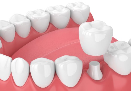 Can an Emergency Dentist Provide You with a Permanent Crown on the Same Day of Your Visit?