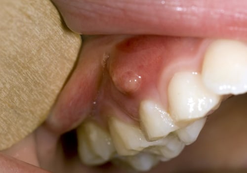 How to Treat and Prevent Gum Infection